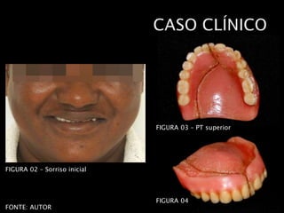 FIGURA 02 – Sorriso inicial
FONTE: AUTOR
FIGURA 03 – PT superior
FIGURA 04
 