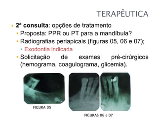  2ª consulta: opções de tratamento
• Proposta: PPR ou PT para a mandíbula?
• Radiografias periapicais (figuras 05, 06 e 07);
• Exodontia indicada
• Solicitação de exames pré-cirúrgicos
(hemograma, coagulograma, glicemia).
FIGURAS 06 e 07
FIGURA 05
 