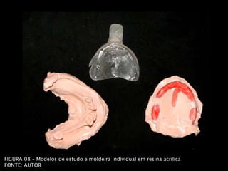 FIGURA 08 – Modelos de estudo e moldeira individual em resina acrílica
FONTE: AUTOR
 