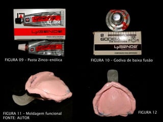 FIGURA 11 – Moldagem funcional
FONTE: AUTOR
FIGURA 09 – Pasta Zinco-enólica FIGURA 10 – Godiva de baixa fusão
FIGURA 12
 