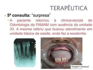  5ª consulta: “surpresa”
• A paciente retornou à clínica-escola de
Odontologia da FAMAM com ausência da unidade
33. A mesma referiu que buscou atendimento em
unidade básica de saúde, onde fez a exodontia.
Imagem intraoral
 