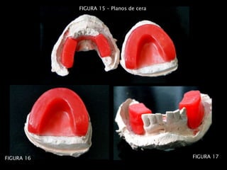 FIGURA 17
FIGURA 15 – Planos de cera
FIGURA 16
 