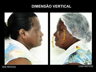 COM PRÓTESE
DIMENSÃO VERTICAL
SEM PRÓTESE
 