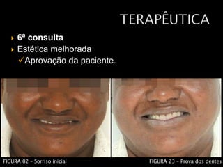  6ª consulta
 Estética melhorada
Aprovação da paciente.
FIGURA 02 – Sorriso inicial FIGURA 23 – Prova dos dentes
 