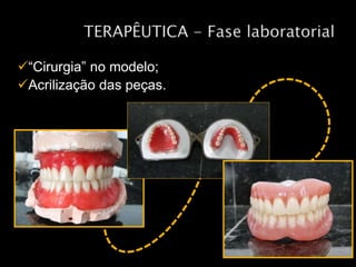 “Cirurgia” no modelo;
Acrilização das peças.
 