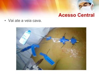 Acesso Central
• Vai ate a veia cava.
 