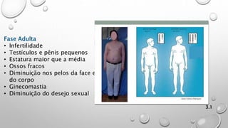 3.1
Fase Adulta
• Infertilidade
• Testículos e pênis pequenos
• Estatura maior que a média
• Ossos fracos
• Diminuição nos pelos da face e
do corpo
• Ginecomastia
• Diminuição do desejo sexual
 