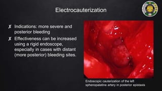 Electrocauterization
✘ Indications: more severe and
posterior bleeding
✘ Effectiveness can be increased
using a rigid endoscope,
especially in cases with distant
(more posterior) bleeding sites.
Endoscopic cauterization of the left
sphenopalatine artery in posterior epistaxis
 