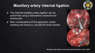 Maxillary artery internal ligation
✘ The Internal maxillary artery ligation can be
performed using a transantral, transoral and
endoscopic
✘ Main complications of this approach: cheek
swelling and trismus y can last for three months
Maxillary artery ligation with endoscope (Sasindran & Jhon, 2020)
 