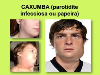 CAXUMBA (parotidite
infecciosa ou papeira)
 