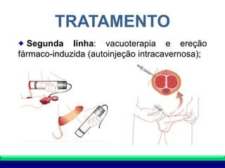 TRATAMENTO
Segunda linha: vacuoterapia e ereção
fármaco-induzida (autoinjeção intracavernosa);
 