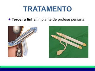 TRATAMENTO
Terceira linha: implante de prótese peniana.
 