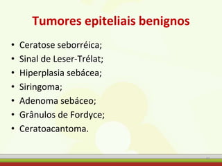 Tumores epiteliais benignos
• Ceratose seborréica;
• Sinal de Leser-Trélat;
• Hiperplasia sebácea;
• Siringoma;
• Adenoma sebáceo;
• Grânulos de Fordyce;
• Ceratoacantoma.
41
 