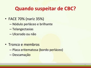 Quando suspeitar de CBC?
• FACE 70% (nariz 35%)
– Nódulo perláceo e brilhante
– Telangectasias
– Ulcerado ou não
• Tronco e membros
– Placa eritematosa (bordo perláceo)
– Descamação
51
 