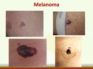 Melanoma
60
 