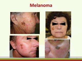 Melanoma
61
 