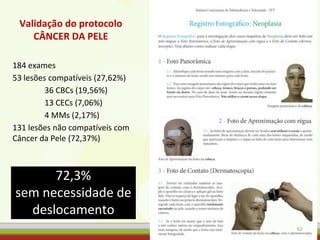 Validação do protocolo
CÂNCER DA PELE
184 exames
53 lesões compatíveis (27,62%)
36 CBCs (19,56%)
13 CECs (7,06%)
4 MMs (2,17%)
131 lesões não compatíveis com
Câncer da Pele (72,37%)
62
72,3%
sem necessidade de
deslocamento
 