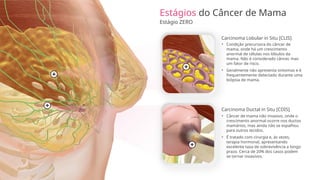 Estágios do Câncer de Mama
Estágio ZERO
Carcinoma Lobular in Situ [CLIS]
Carcinoma Ductal in Situ [CDIS]
• Câncer de mama não invasivo, onde o
crescimento anormal ocorre nos ductos
mamários, mas ainda não se espalhou
para outros tecidos.
• É tratado com cirurgia e, às vezes,
terapia hormonal, apresentando
excelente taxa de sobrevivência a longo
prazo. Cerca de 20% dos casos podem
se tornar invasivos.
• Condição precursora do câncer de
mama, onde há um crescimento
anormal de células nos lóbulos da
mama. Não é considerado câncer, mas
um fator de risco.
• Geralmente não apresenta sintomas e é
frequentemente detectado durante uma
biópsia de mama.
 