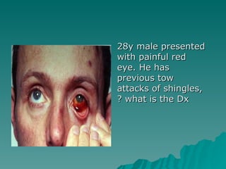 28y male presented with painful red eye. He has previous tow attacks of shingles, what is the Dx ? 