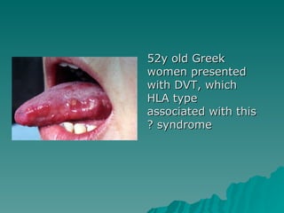 52y old Greek women presented with DVT, which HLA type associated with this syndrome ? 