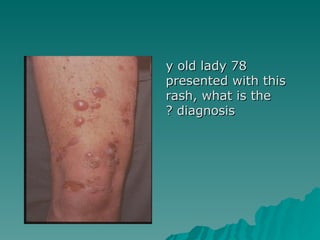 78 y old lady presented with this rash, what is the diagnosis ? 
