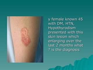 45 y female known with DM, HTN, Hypothyrodism presented with this skin lesion which enlarging over the last 2 months what is the diagnosis ? 