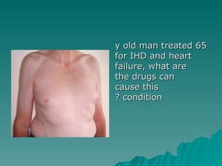 65 y old man treated for IHD and heart failure, what are the drugs can cause this condition ? 