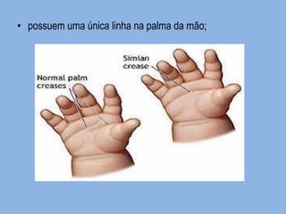 •possuem uma única linha na palma da mão; 
 