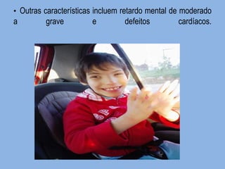 • Outras características incluem retardo mental de moderado a grave e defeitos cardíacos.  