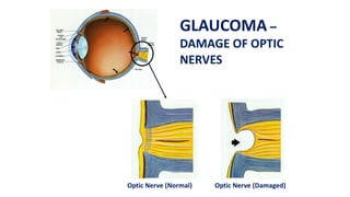 Optic Nerve (Normal) Optic Nerve (Damaged)
GLAUCOMA –
DAMAGE OF OPTIC
NERVES
 