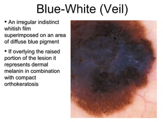 Blue-White (Veil)
 An irregular indistinct
whitish film
superimposed on an area
of diffuse blue pigment
 If overlying the raised
portion of the lesion it
represents dermal
melanin in combination
with compact
orthokeratosis
 