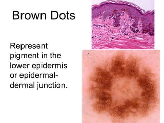 Brown Dots
Represent
pigment in the
lower epidermis
or epidermal-
dermal junction.
 