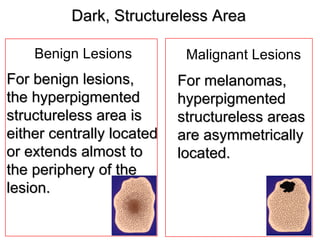 Dark, Structureless Area

    Benign Lesions          Malignant Lesions
For benign lesions,        For melanomas,
the hyperpigmented         hyperpigmented
structureless area is      structureless areas
either centrally located   are asymmetrically
or extends almost to       located.
the periphery of the
lesion.
 