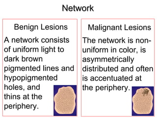 Network

  Benign Lesions       Malignant Lesions
A network consists    The network is non-
of uniform light to   uniform in color, is
dark brown            asymmetrically
pigmented lines and   distributed and often
hypopigmented         is accentuated at
holes, and            the periphery.
thins at the
periphery.
 