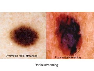Symmetric radial streaming
                                    Focal radial streaming

                       Radial streaming
 