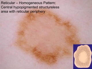 Reticular – Homogeneous Pattern:
Central hypopigmented structureless
area with reticular periphery
 