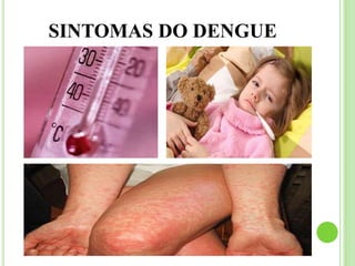 SINTOMAS DO DENGUE
 