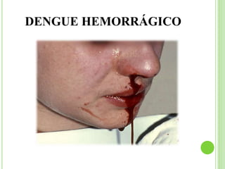 DENGUE HEMORRÁGICO
 