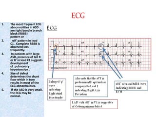 ECG
1. The most frequent ECG
abnormalities in ASD
are right bundle branch
block (RBBB)
pattern or
2. rsR' pattern in lead
C1 . Complete RBBB is
observed less
frequently.
3. In patients with large
ASD, presence of tall R
or R' in lead C1 suggests
development
of pulmonary
hypertension .
4. Size of defect
determines the shunt
flow which in turn
results in most of the
ECG abnormalities.
5. If the ASD is very small,
the ECG may be
normal.
 
