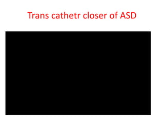 Trans cathetr closer of ASD
 