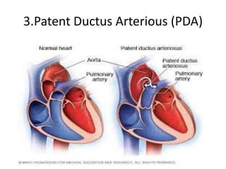 3.Patent Ductus Arterious (PDA)
 