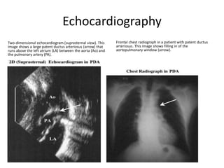 Echocardiography
Two-dimensional echocardiogram (suprasternal view). This
image shows a large patent ductus arteriosus (arrow) that
runs above the left atrium (LA) between the aorta (Ao) and
the pulmonary artery (PA).
Frontal chest radiograph in a patient with patent ductus
arteriosus. This image shows filling in of the
aortopulmonary window (arrow).
 