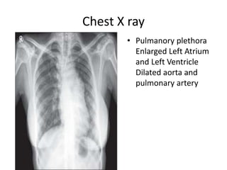 Chest X ray
• Pulmanory plethora
Enlarged Left Atrium
and Left Ventricle
Dilated aorta and
pulmonary artery
 