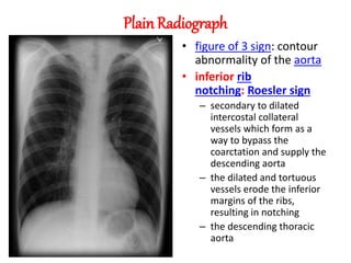 Plain Radiograph
• figure of 3 sign: contour
abnormality of the aorta
• inferior rib
notching: Roesler sign
– secondary to dilated
intercostal collateral
vessels which form as a
way to bypass the
coarctation and supply the
descending aorta
– the dilated and tortuous
vessels erode the inferior
margins of the ribs,
resulting in notching
– the descending thoracic
aorta
 