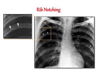 Rib Notching
 