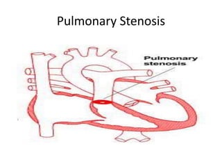 Pulmonary Stenosis
 