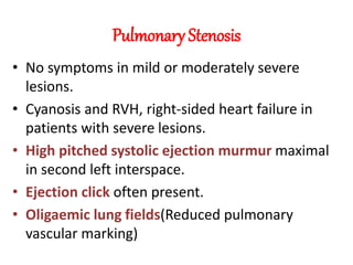 Pulmonary Stenosis
• No symptoms in mild or moderately severe
lesions.
• Cyanosis and RVH, right-sided heart failure in
patients with severe lesions.
• High pitched systolic ejection murmur maximal
in second left interspace.
• Ejection click often present.
• Oligaemic lung fields(Reduced pulmonary
vascular marking)
 