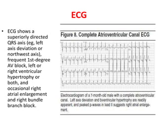 ECG
• ECG shows a
superiorly directed
QRS axis (eg, left
axis deviation or
northwest axis),
frequent 1st-degree
AV block, left or
right ventricular
hypertrophy or
both, and
occasional right
atrial enlargement
and right bundle
branch block.
 