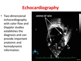 Echocardiography
• Two-dimensional
echocardiography
with color flow and
Doppler studies
establishes the
diagnosis and can
provide important
anatomic and
hemodynamic
information.
 