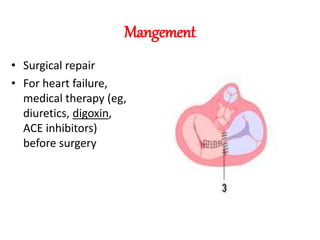Mangement
• Surgical repair
• For heart failure,
medical therapy (eg,
diuretics, digoxin,
ACE inhibitors)
before surgery
 